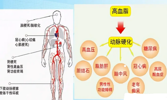 干细胞改善高血脂，有效预防三高”并发症