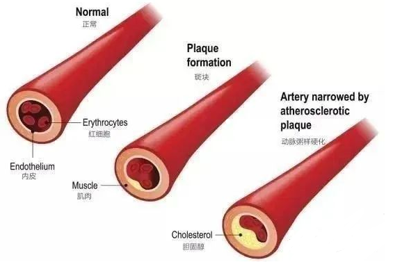 干细胞改善高血脂，有效预防三高”并发症