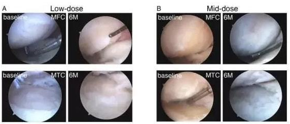 干细胞治疗膝骨关节炎临床试验结果喜人