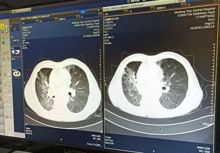 干细胞治疗肺纤维化的临床案例