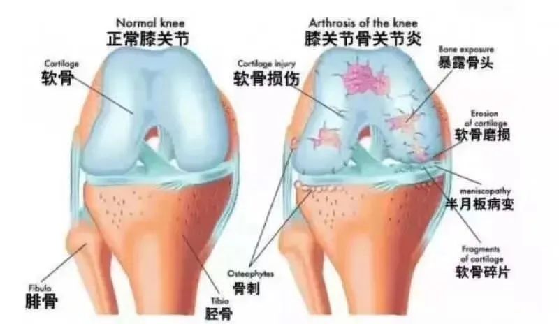 膝关节病症治疗的法宝：干细胞修复膝关节损伤，促进软骨再生！