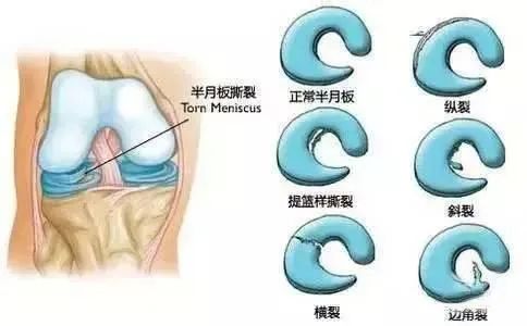 膝关节病症治疗的法宝：干细胞修复膝关节损伤，促进软骨再生！