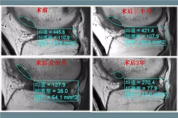 膝关节病症治疗的法宝：干细胞修复膝关节损伤，促进软骨再生！