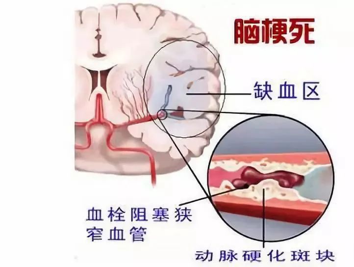 资讯：干细胞为脑梗塞后遗症患者带来新的希望