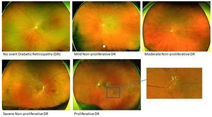 干细胞治疗糖尿病视网膜病变导致的飞蚊症、视力下降、失明等